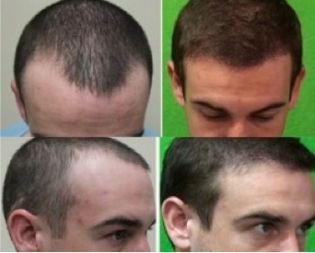 Best hairline reconstruction and hair restoration services now possible!