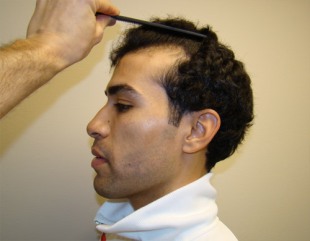 Best hairline reconstruction and hair restoration services now possible